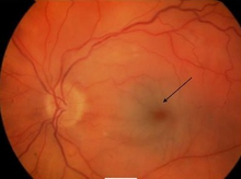Cherry-red spot with retinal pallor typical of central retinal artery occlusion