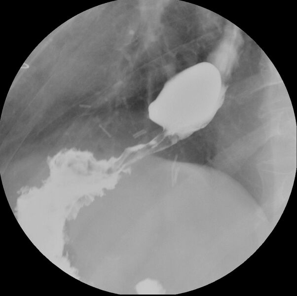 File:"Ballooning" of the distal esophagus after Heller myotomy (Radiopaedia 38485-40572 Prone RAO 1).jpg