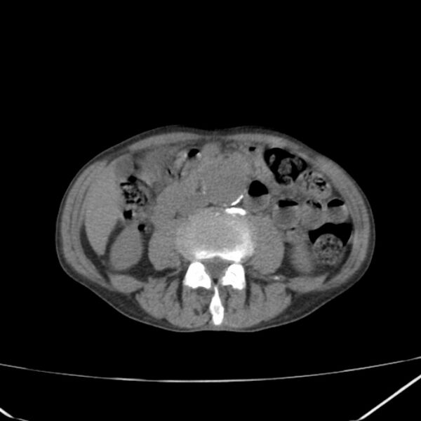 File:Abdominal aortic aneurysm (Radiopaedia 23703-23856 Axial non-contrast 28).jpg