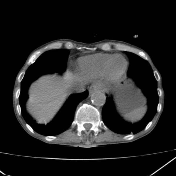 File:Abdominal aortic aneurysm (Radiopaedia 23703-23856 Axial non-contrast 5).jpg