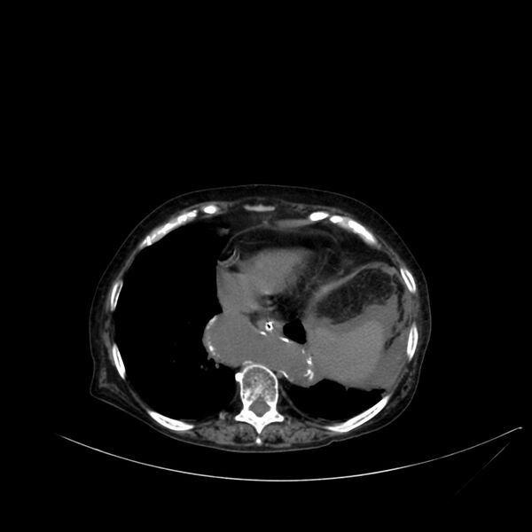 File:Abdominal aortic aneurysm - impending rupture (Radiopaedia 19233-19246 Axial non-contrast 18).jpg