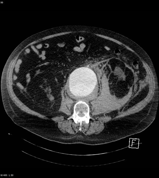 File:Abdominal aortic aneurysm with intramural hematoma then rupture (Radiopaedia 50278-55632 Axial C+ arterial phase 98).jpg