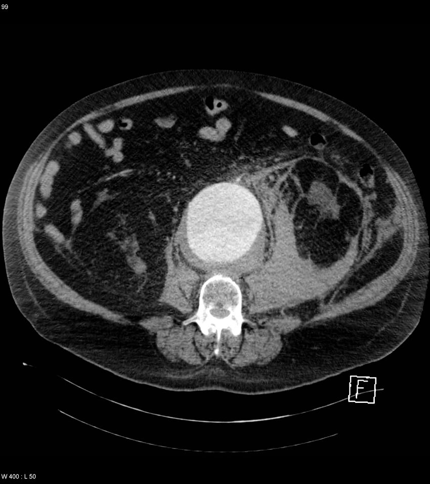 Abdominal aortic aneurysm with intramural hematoma then rupture (Radiopaedia 50278-55632 Axial C+ arterial phase 98).jpg