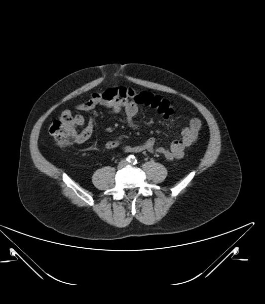 File:Abdominal aortic aneurysm with thrombus fissuration (Radiopaedia 46218-50618 Axial non-contrast 35).jpg