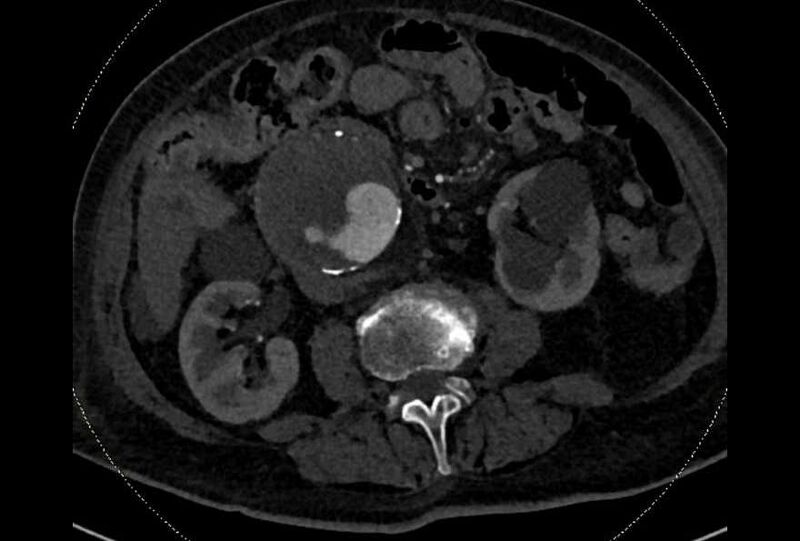 File:Abdominal aortic aneurysm with thrombus fissuration (Radiopaedia 73192-83919 Axial C+ arterial phase 98).jpg