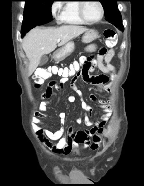 File:Abdominal wall metastasis from colorectal carcinoma (Radiopaedia 31016-31717 Coronal C+ portal venous phase 13).jpg