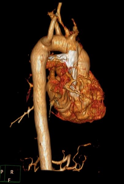 File:Aberrant right subclavian artery (Radiopaedia 67135-76475 B 1).jpg