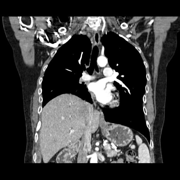 File:Acquired adrenal hyperplasia - due to thymic carcinoid tumor (Radiopaedia 21269-21184 C 1).jpg