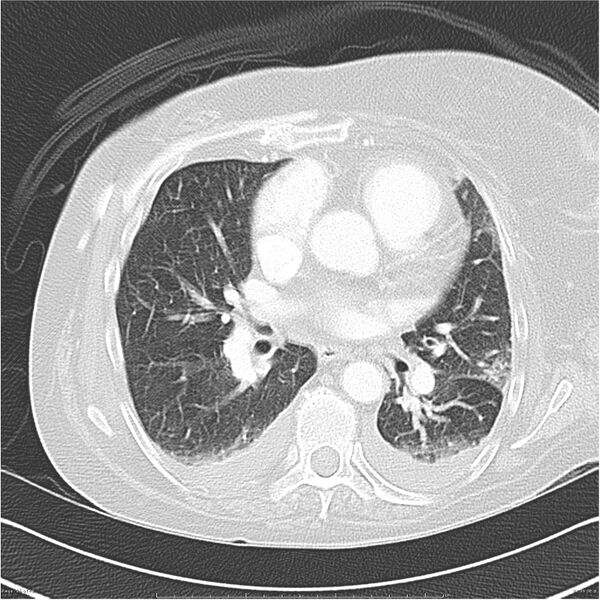 File:Acute-on-chronic pulmonary emboli (Radiopaedia 27925-28169 lung window 26).jpg