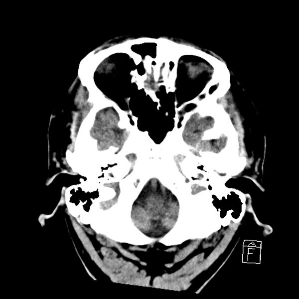 File:Acute P1 occlusion with PCA ischemia penumbra (CT perfusion) (Radiopaedia 72084-82586 Axial non-contrast 5).jpg