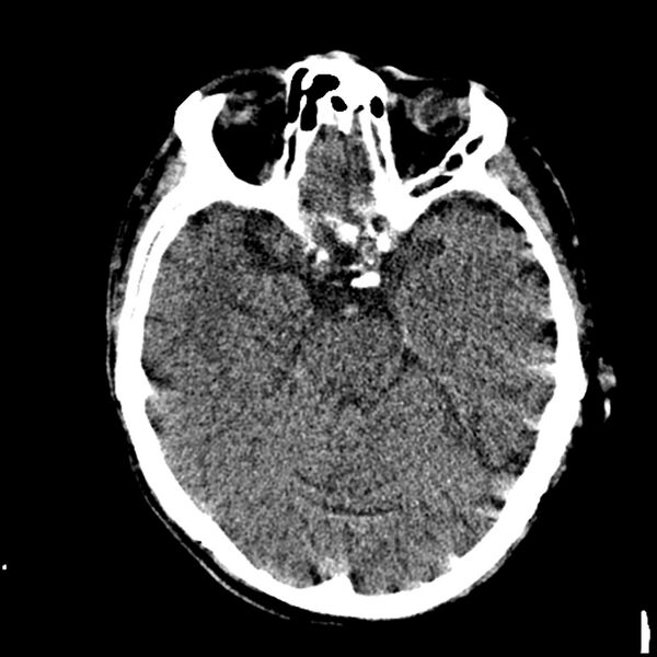 File:Acute P1 occlusion with PCA ischemia penumbra (CT perfusion) (Radiopaedia 72084-82586 Axial non-contrast thins 2).jpg