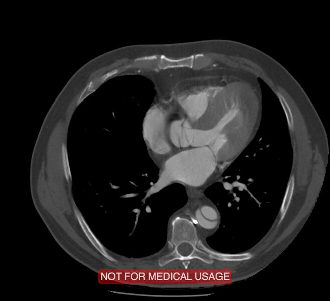File:Acute aortic dissection - Stanford type A (Radiopaedia 40661-43285 Axial C+ arterial phase 43).jpg