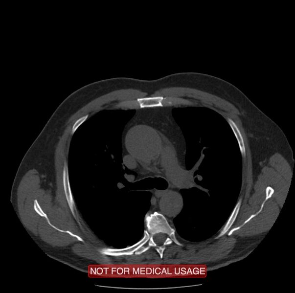 File:Acute aortic dissection - Stanford type A (Radiopaedia 40661-43285 Axial non-contrast 16).jpg