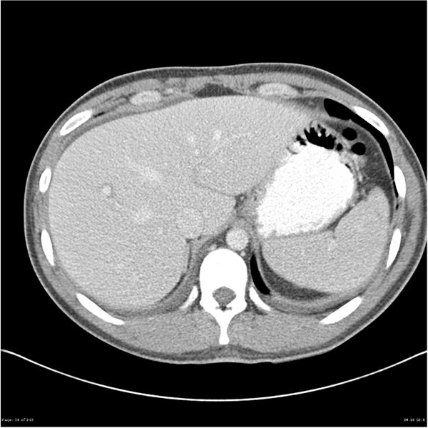 File:Acute appendicitis (Radiopaedia 25364-25615 B 6).jpg
