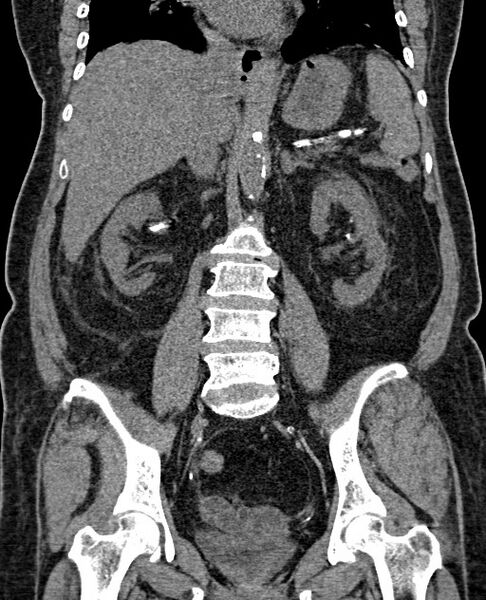 File:Acute appendicitis (Radiopaedia 58627-65818 Coronal non-contrast 45).jpg