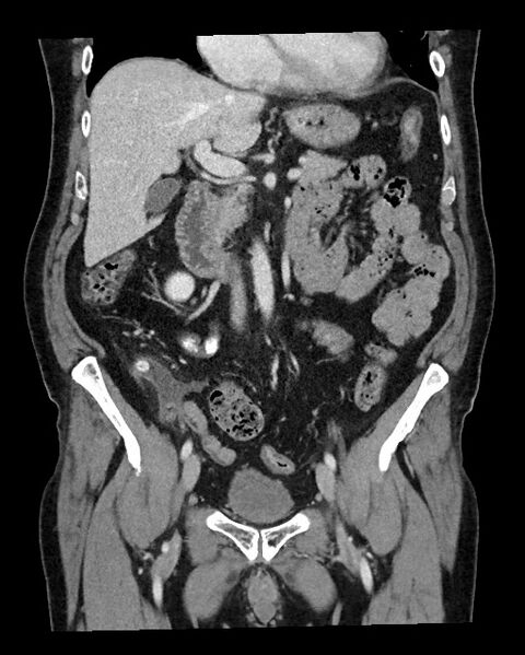 File:Acute appendicitis - large appendicoliths (Radiopaedia 61805-69820 Coronal C+ portal venous phase 60).jpg