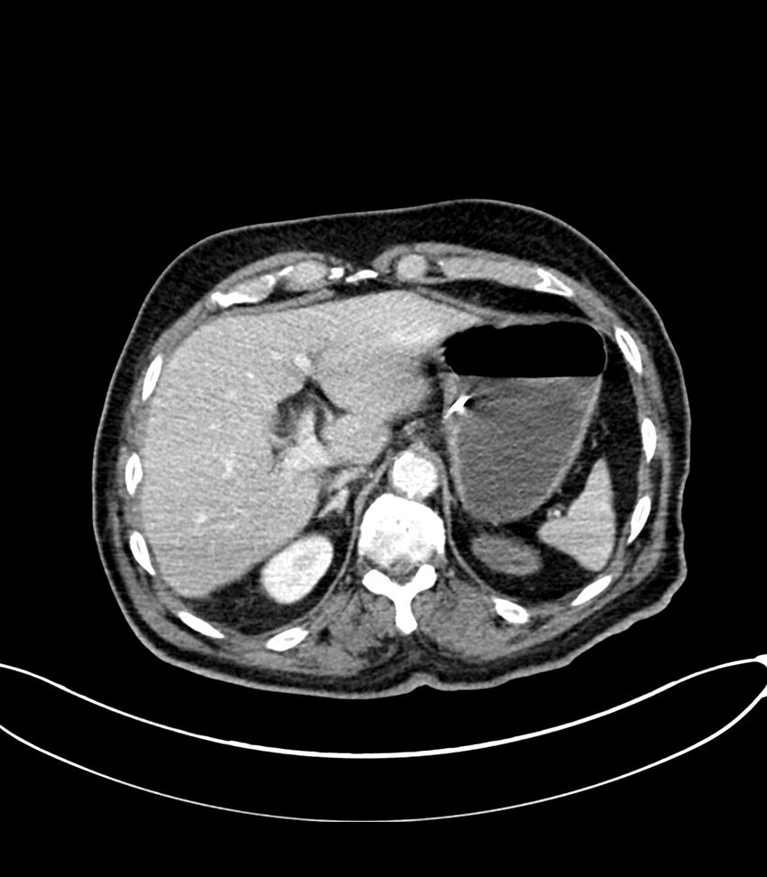 Acute arterial mesenteric ischemia (Radiopaedia 78238-90828 Axial C+ portal venous phase 33).jpg