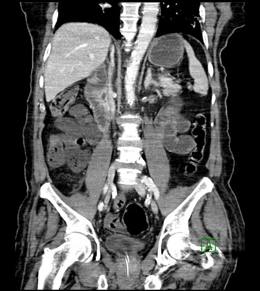 File:Acute arterial mesenteric ischemia (Radiopaedia 78238-90828 Coronal C+ portal venous phase 56).jpg
