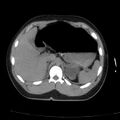 Acute aspiration pneumonitis (Radiopaedia 33605-34703 Axial non-contrast 83).jpg