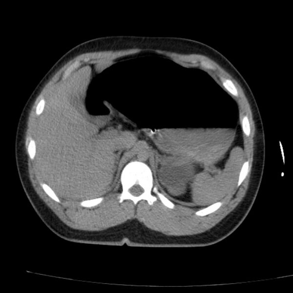 File:Acute aspiration pneumonitis (Radiopaedia 33605-34703 Axial non-contrast 83).jpg