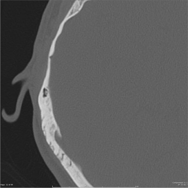 File:Acute otomastoiditis (Radiopaedia 28276-28512 Axial PTB bone window reformat 12).jpg
