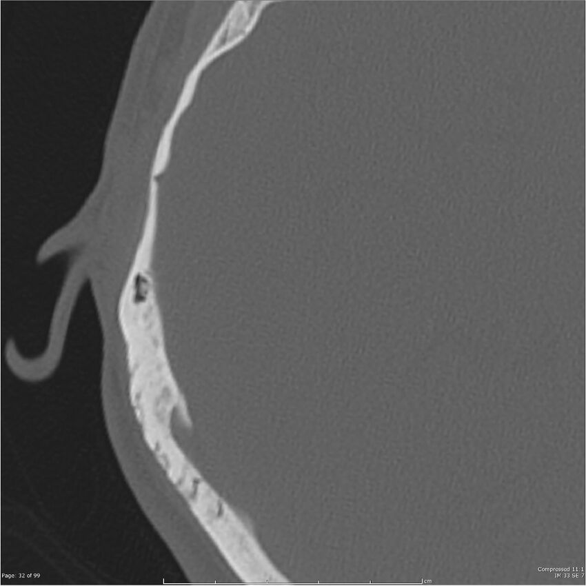 Acute otomastoiditis (Radiopaedia 28276-28512 Axial PTB bone window reformat 12).jpg