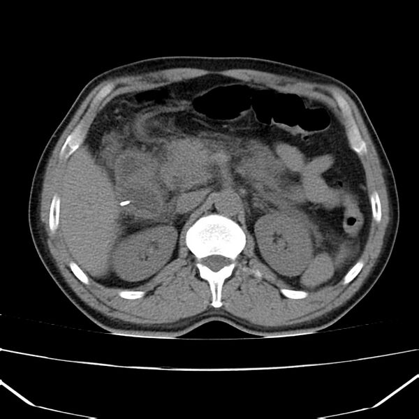File:Acute pancreatitis (Radiopaedia 22572-22596 Axial non-contrast 22).jpg