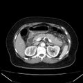Acute pancreatitis - Balthazar C (Radiopaedia 26569-26714 Axial C+ arterial phase 30).jpg