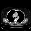 Acute pancreatitis - Balthazar C (Radiopaedia 26569-26714 Axial C+ portal venous phase 1).jpg