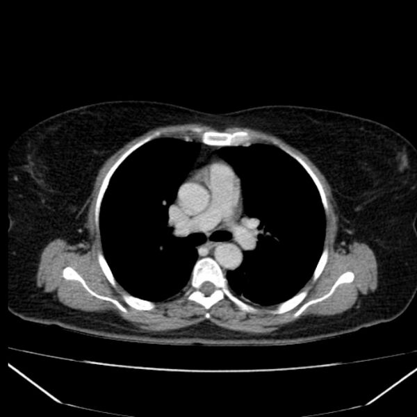 File:Acute pancreatitis - Balthazar C (Radiopaedia 26569-26714 Axial C+ portal venous phase 1).jpg