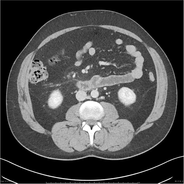 File:Acute pancreatitis - mild (Radiopaedia 27796-28033 C+ portal venous phase 28).jpg