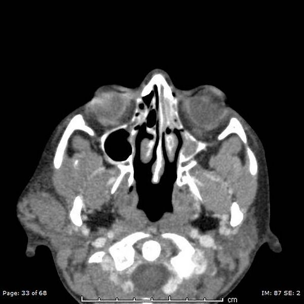 File:Acute parotitis (Radiopaedia 54123-60294 Axial C+ arterial phase 7).jpg