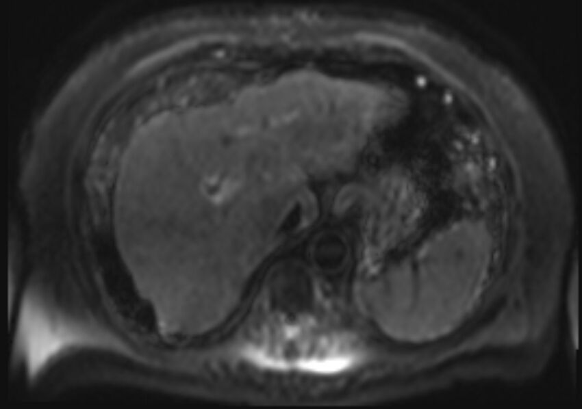 Acute portal vein thrombosis (Radiopaedia 73198-83925 Axial DWI 11).jpg