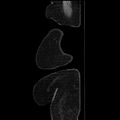 Acute pyelonephritis (Radiopaedia 25657-25837 Sagittal renal parenchymal phase 7).jpg