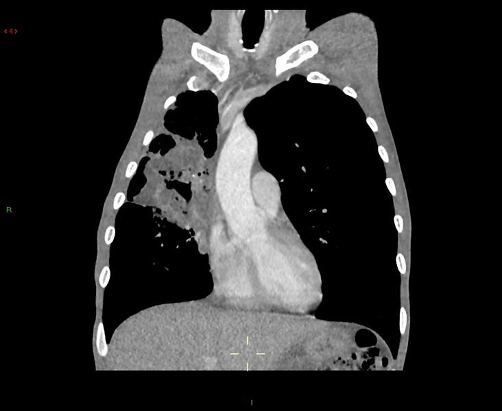 File:Acute right lung abscess (Radiopaedia 34806-36258 Coronal C+ arterial phase 38).jpg