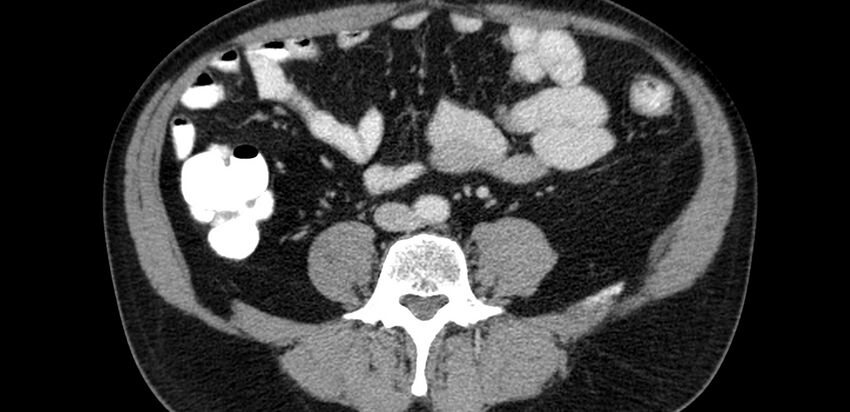 Acute sigmoid colon diverticulitis (Radiopaedia 55507-61976 Axial C+ portal venous phase 43).jpg