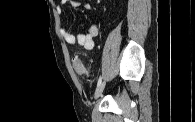 File:Acute sigmoid colon diverticulitis (Radiopaedia 55507-61976 Sagittal C+ portal venous phase 64).jpg