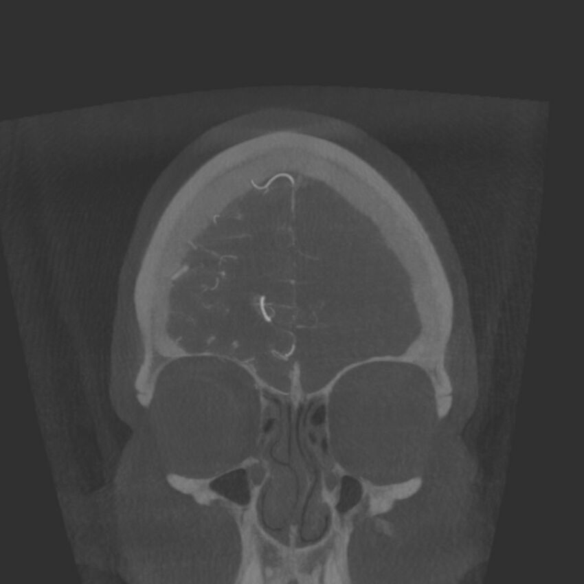 Acute subarachnoid hemorrhage and accessory anterior cerebral artery (Radiopaedia 69231-79010 Coronal arterial - MIP 14).jpg