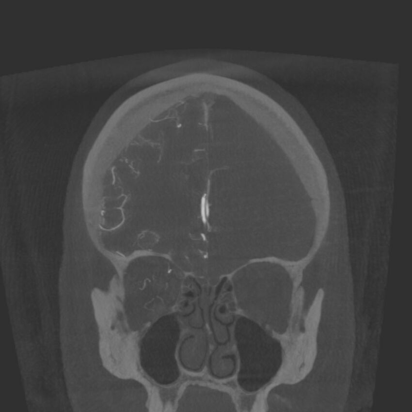 Acute subarachnoid hemorrhage and accessory anterior cerebral artery (Radiopaedia 69231-79010 Coronal arterial - MIP 23).jpg
