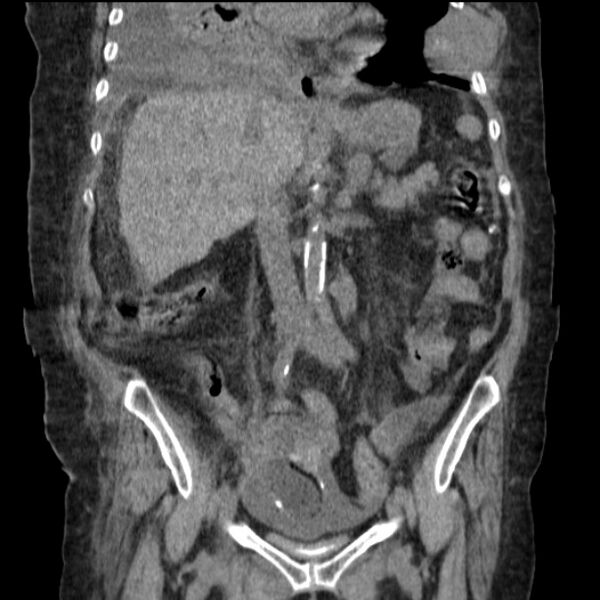 File:Acute tubular necrosis (Radiopaedia 28077-28334 D 45).jpg