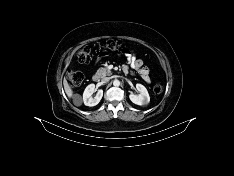 File:Adenocarcinoma of pancreas with hepatic metastasis (Radiopaedia 64332-73122 Axial C+ portal venous phase 40).jpg