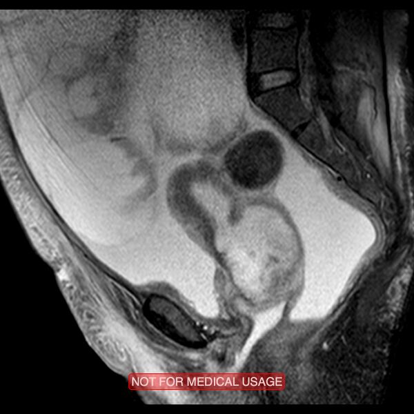 File:Adenocarcinoma of the cervix (Radiopaedia 28373-28615 Sagittal T2 fat sat 10).jpg