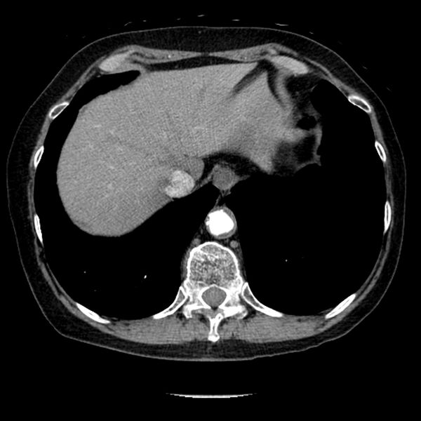 File:Adenocarcinoma of the lung (Radiopaedia 41015-43755 Axial C+ portal venous phase 104).jpg