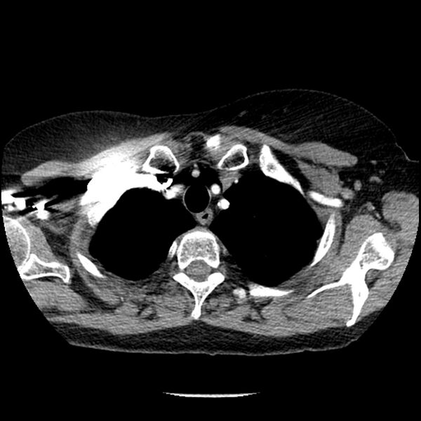 File:Adenocarcinoma of the lung (Radiopaedia 41015-43755 Axial C+ portal venous phase 16).jpg
