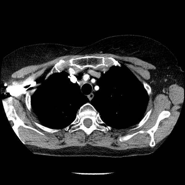 File:Adenocarcinoma of the lung (Radiopaedia 41015-43755 Axial C+ portal venous phase 21).jpg
