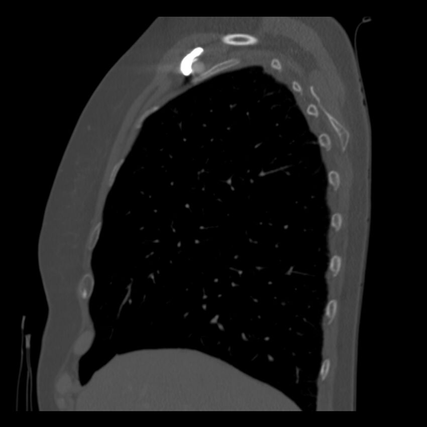 Adenocarcinoma of the lung (Radiopaedia 41015-43755 Sagittal bone window 21).jpg