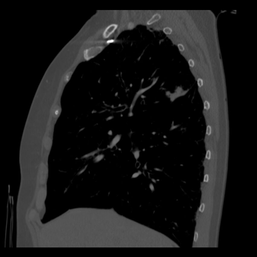 Adenocarcinoma of the lung (Radiopaedia 41015-43755 Sagittal bone window 33).jpg