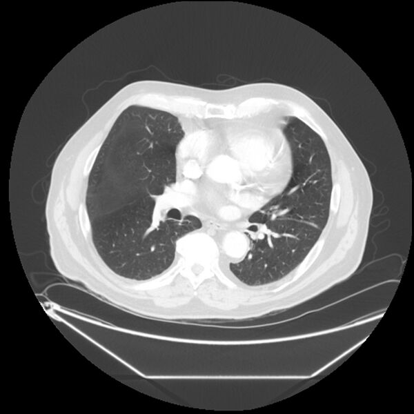 File:Adenocarcinoma of the lung (Radiopaedia 44876-48759 Axial lung window 43).jpg