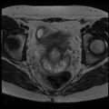 Adenoma malignum of the cervix (Radiopaedia 24460-24765 C 13).jpg
