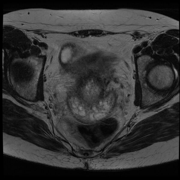 File:Adenoma malignum of the cervix (Radiopaedia 24460-24765 C 13).jpg